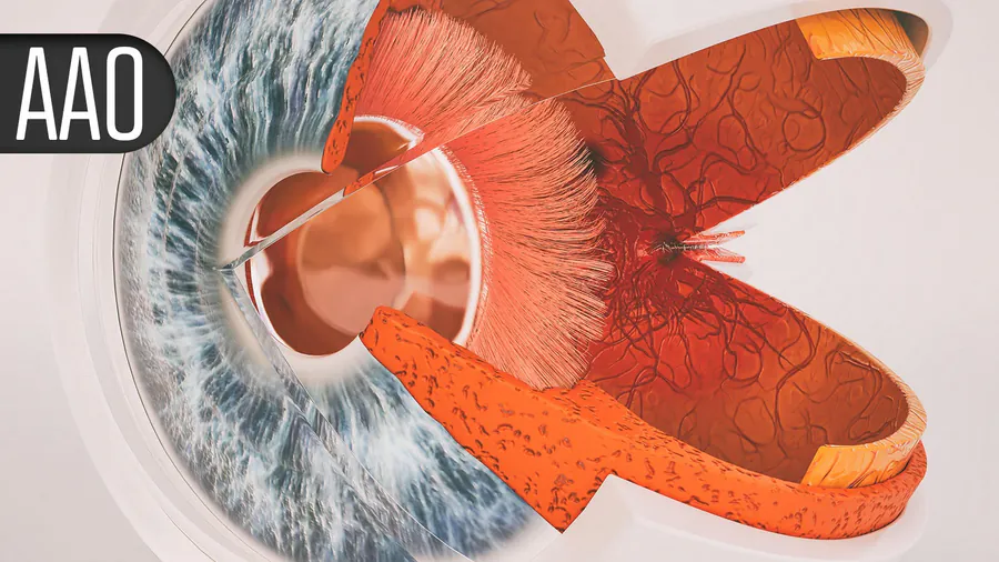 High blood sugar before eye surgery spells trouble — here's what the data shows