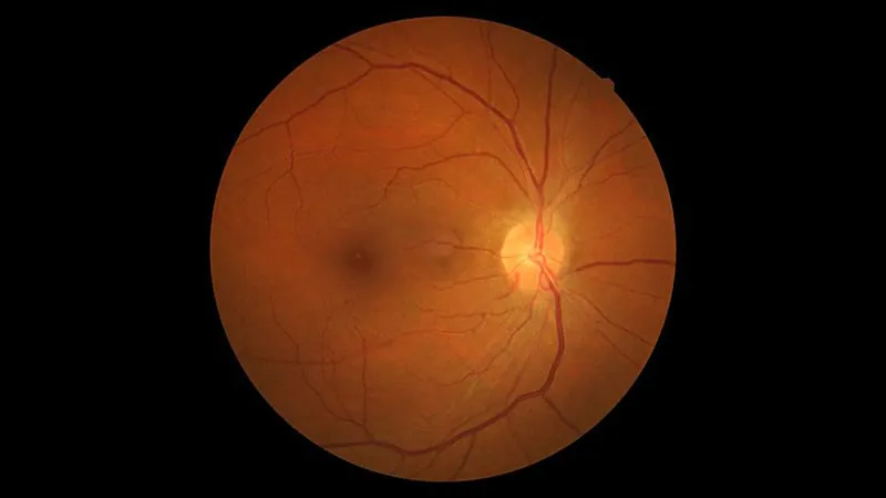 Anti-VEGF therapy for diabetic macular edema linked to nearly 3x higher glaucoma risk