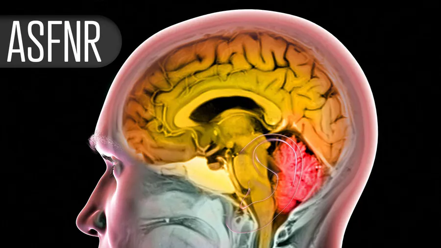 A new imaging marker may explain why some stroke patients don't recover after successful thrombectomy