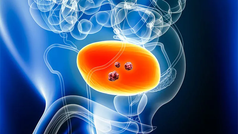 A simple urine test could transform how bladder cancer is diagnosed and treated