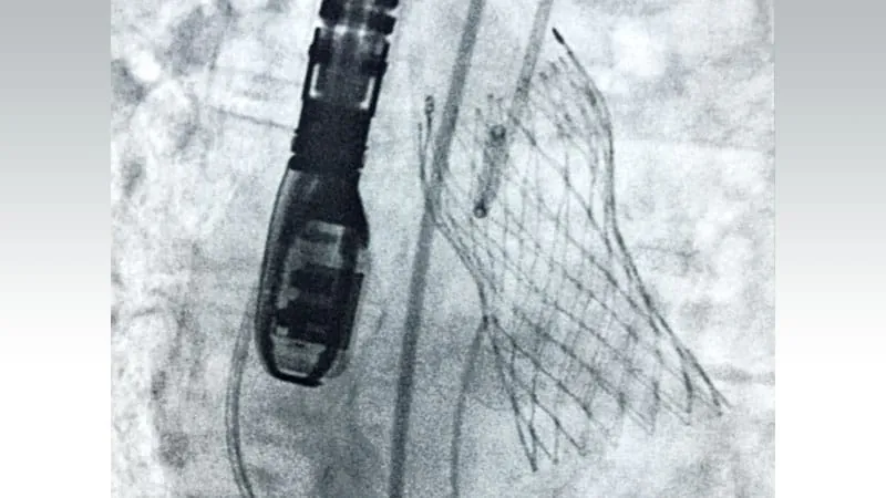 CMS rewrites the TAVR rulebook — cardiologists are cautiously optimistic