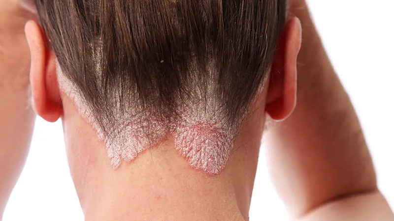 Psoriasis goes skin-deep: fatigue, mood, and nail changes hit body image hard