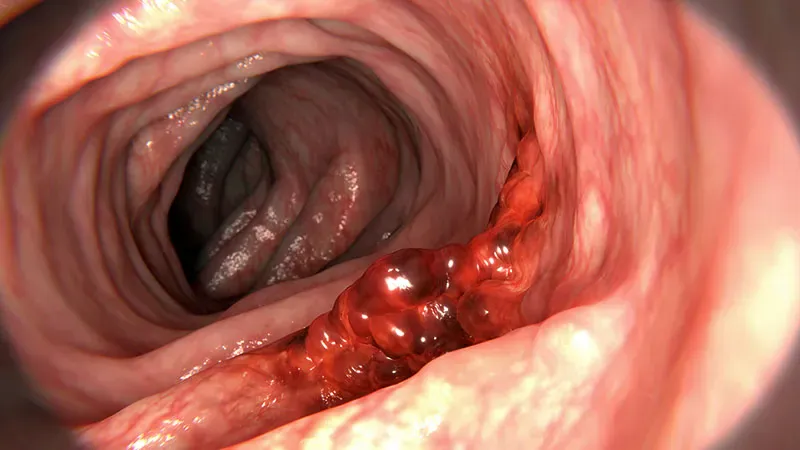Your blood test might reveal your colon cancer risk before symptoms do
