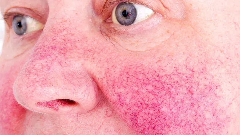 Ear acupressure gives rosacea treatment a meaningful boost