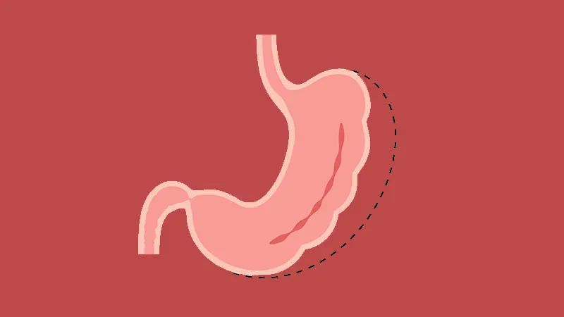 Adding transit bipartition to sleeve gastrectomy slashes GERD risk and boosts weight loss