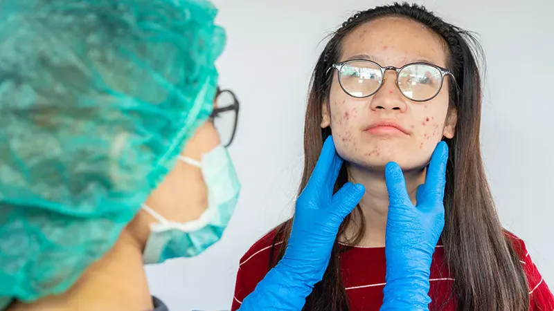 Acne is becoming a global epidemic — and it's only getting worse
