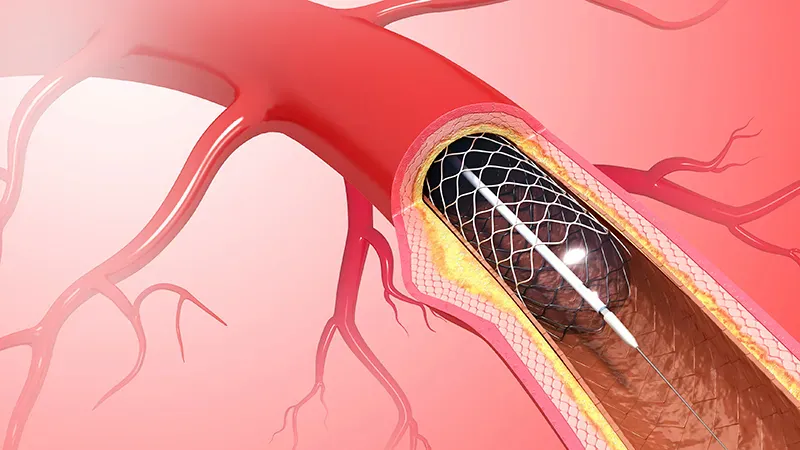 Stenting works better for lipid-rich plaques — and now there's data to prove it