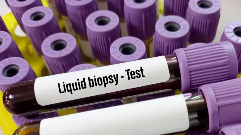 Liquid biopsy tests could finally crack early-stage ovarian cancer detection