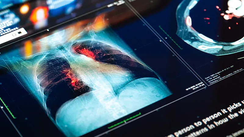Home-based HIIT program boosts fitness in kids with rare lung disease