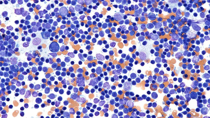 Blood-based MRD testing predicts long-lasting responses to epcoritamab in hard-to-treat lymphoma