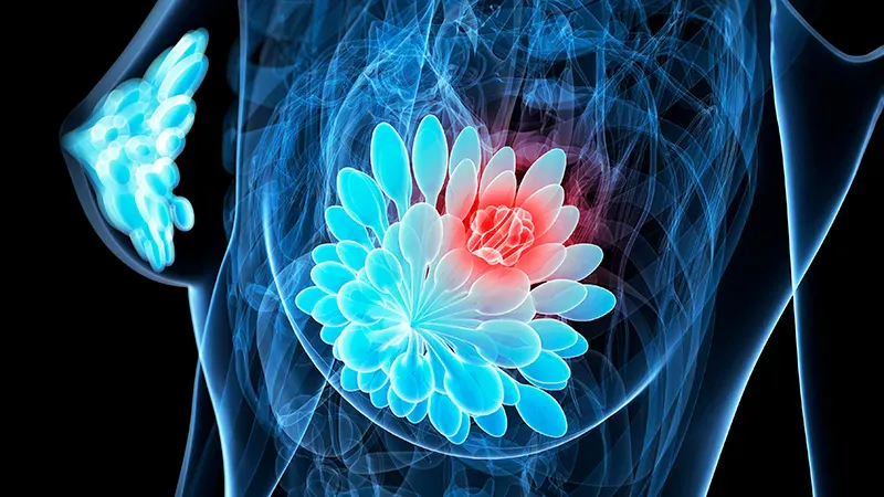 Healthy habits may offset chemo's long-term toll on breast cancer survivors