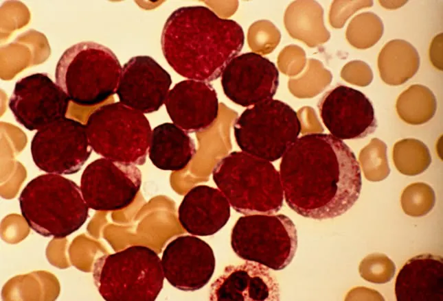Defibrotide prophylaxis cuts liver complication risk in kids with leukemia undergoing stem cell transplant