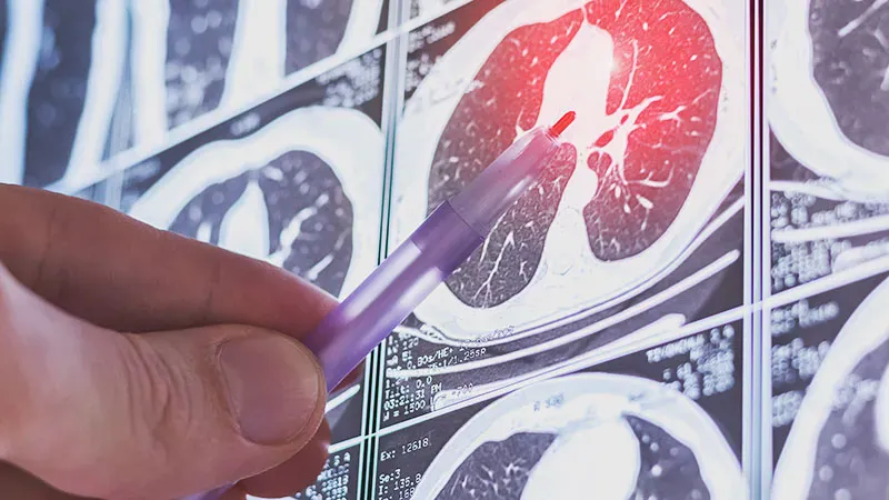 Low-dose CT scans may hint at lung cancer type before biopsy