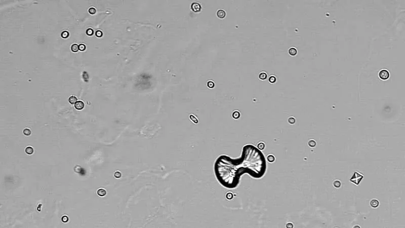 Elevated urine oxalate: What clinicians need to know before acting on the result