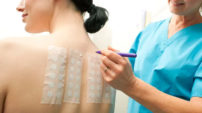Severe allergy history linked to COVID vaccine reactions, but true allergic mechanism remains unclear