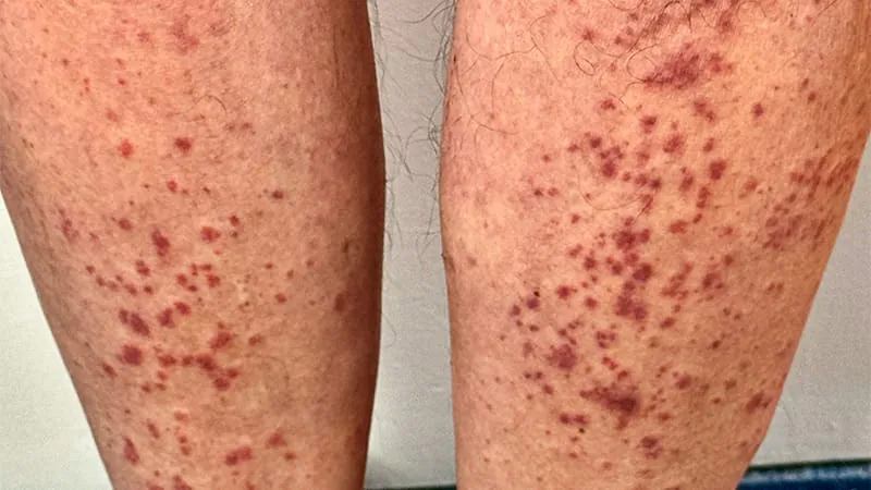 Avacopan shows strong real-world results in vasculitis patients