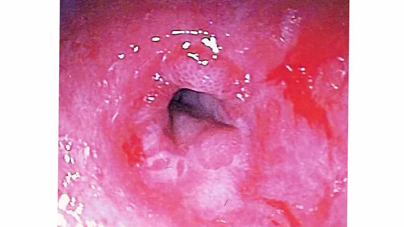 Budesonide tablets slash esophageal stricture risk after cancer-removing endoscopy