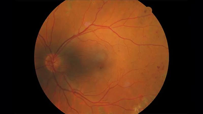 New biologic tarcocimab shows lasting vision benefits in diabetic retinopathy with just twice-yearly dosing