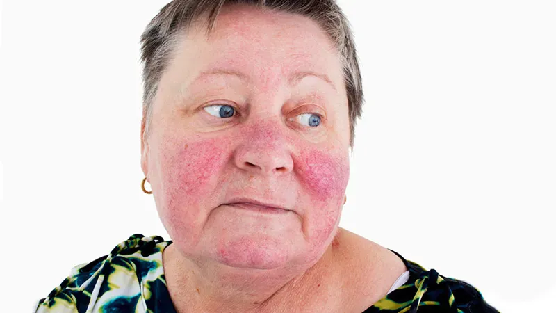 New antibody therapy shows promising skin clearance in cutaneous lupus