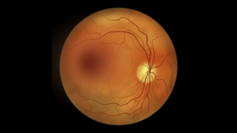 New IL-6 inhibitor shows promise as first nonsteroidal intravitreal treatment for uveitic macular edema