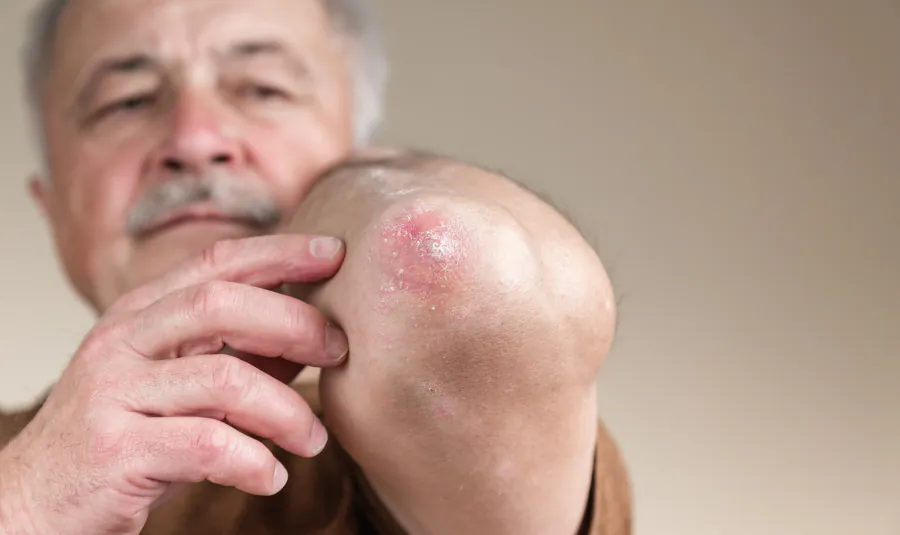 Skin rashes may be the earliest clue to a rare, deadly syndrome in older men
