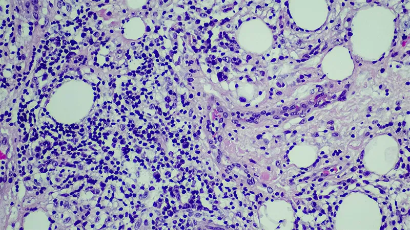 Skin lymphoma rates are falling — and biologics like dupilumab may be why