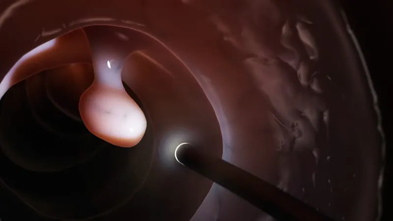 Water-filled colonoscopies are faster and cleaner — and just as effective