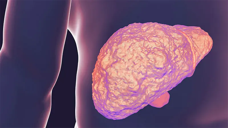 Efruxifermin shows durable liver fibrosis improvements in MASH patients