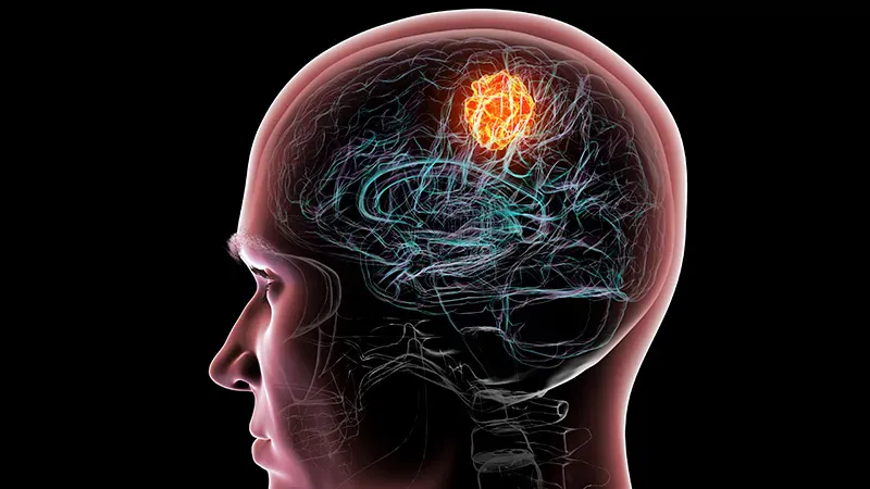 EMA recommends oral temozolomide suspension for glioblastoma in adults and children