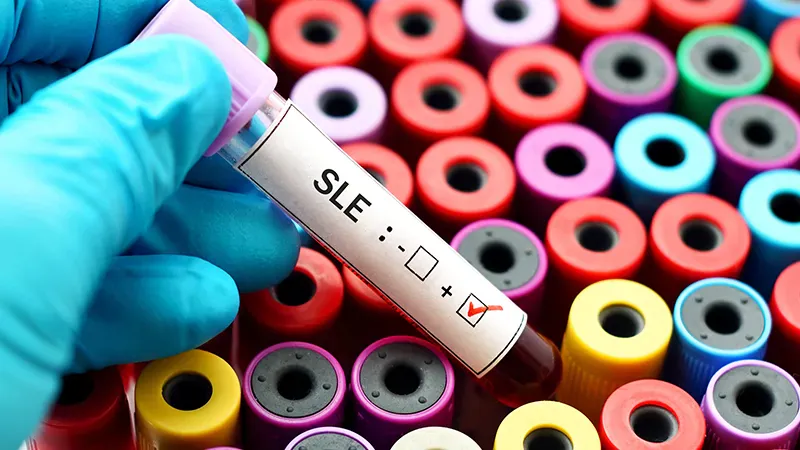 Belimumab cuts steroid use and limits organ damage in lupus patients over 8 years