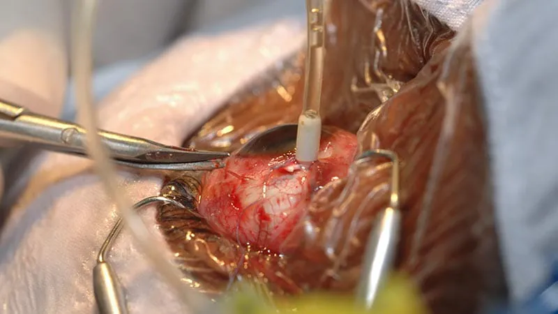 Office-based retinal surgery shows promise — with the right patients