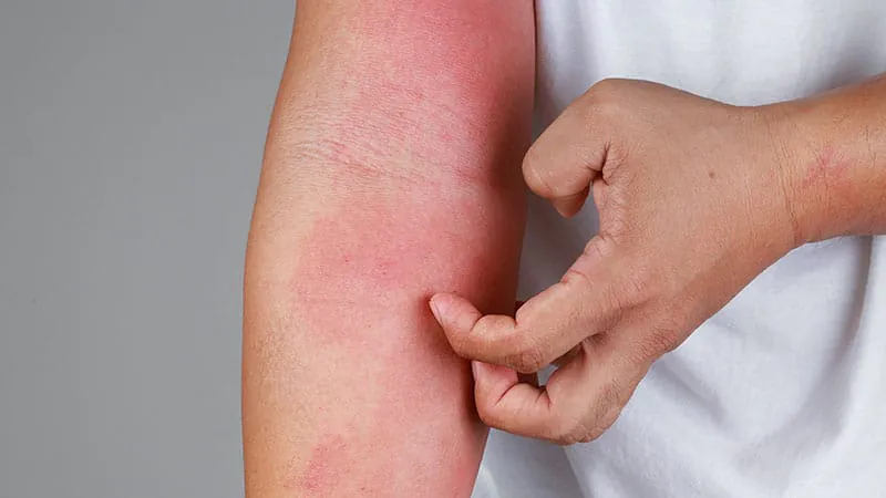 Abrocitinib keeps atopic dermatitis under control for over two years