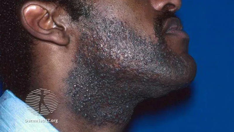 Razor bumps finally get their first-ever clinical guidelines