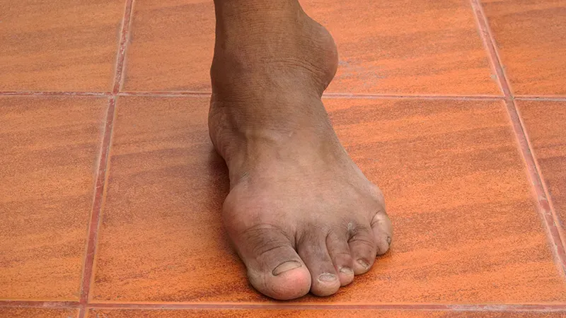 Is "refractory gout" a myth? Experts say better targets and patience may be the real cure