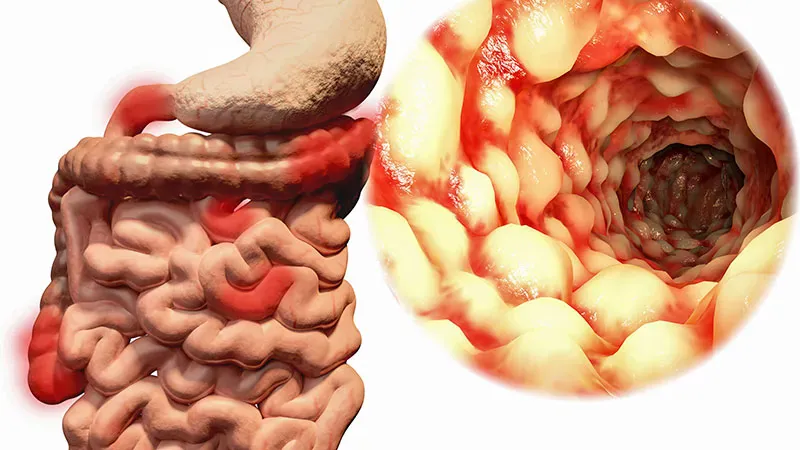 Upadacitinib outperforms rivals in real-world ulcerative colitis treatment