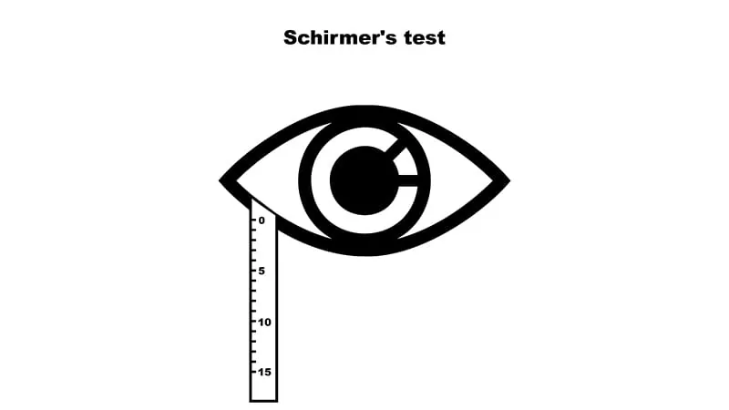 The Schirmer test is falling short in Sjögren diagnosis — but it might still have a future