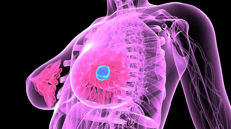 New ADC more than doubles survival time in HER2-low breast cancer