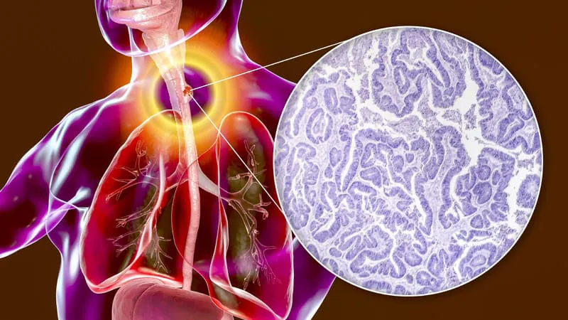 Skipping surgery after chemo-radiation? New data says it might be an option for some esophageal cancer patients