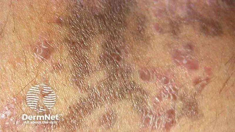 Lichen planus linked to dramatically elevated cancer risk at affected body sites