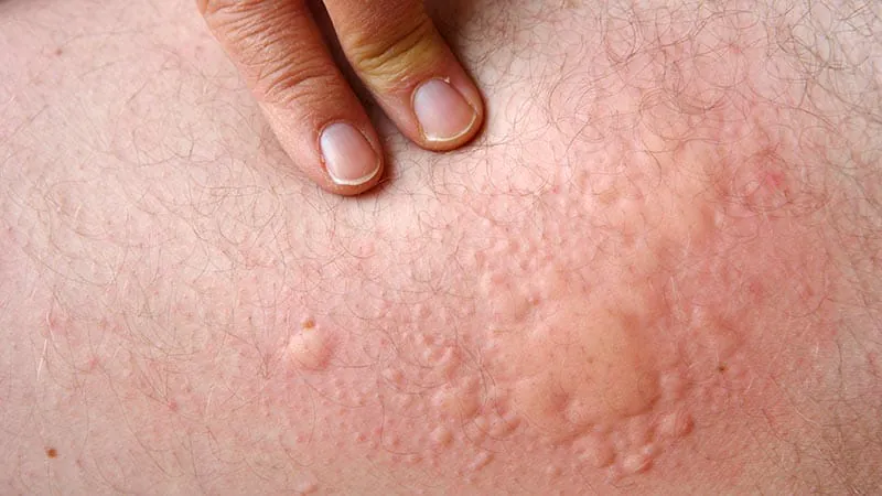 Omalizumab linked to lower cardiovascular risk in chronic hives patients