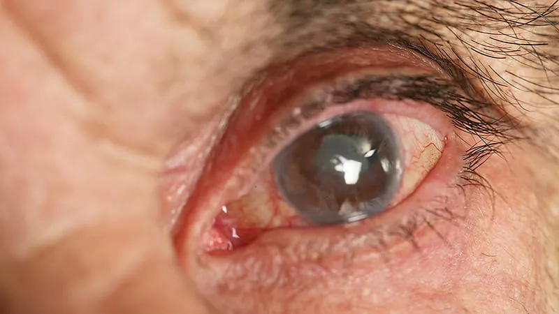 Same-day bilateral cataract surgery shows strong safety profile — but it's not for everyone
