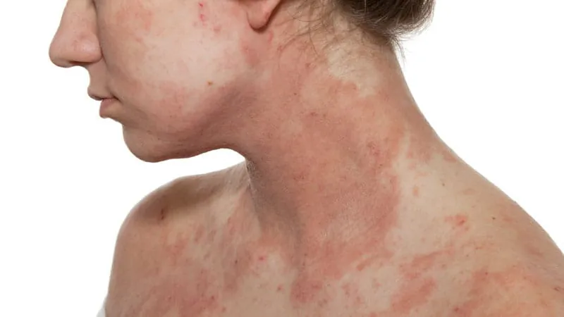 Rituximab vs. belimumab in lupus: No clear winner, study finds