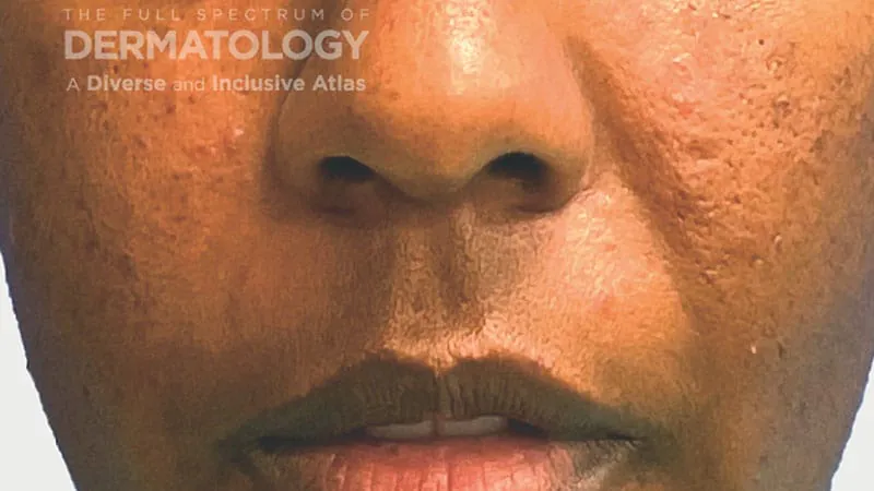 Rosacea doesn't skip darker skin — it just goes unrecognized