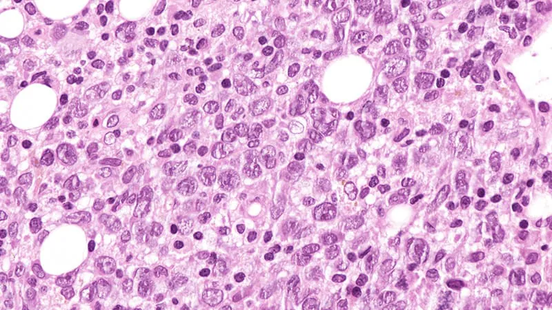 Next-gen CAR T-cell therapy shows strong results in hard-to-treat lymphoma