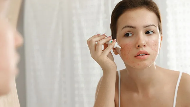 AI is now writing acne prescriptions in Utah — and dermatologists aren't thrilled