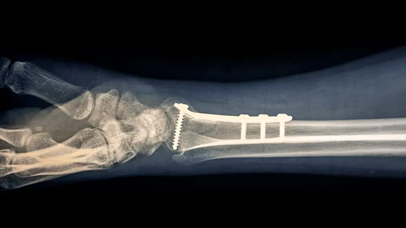 Wrist fracture surgery rarely leads to infection — but antibiotic use varies widely