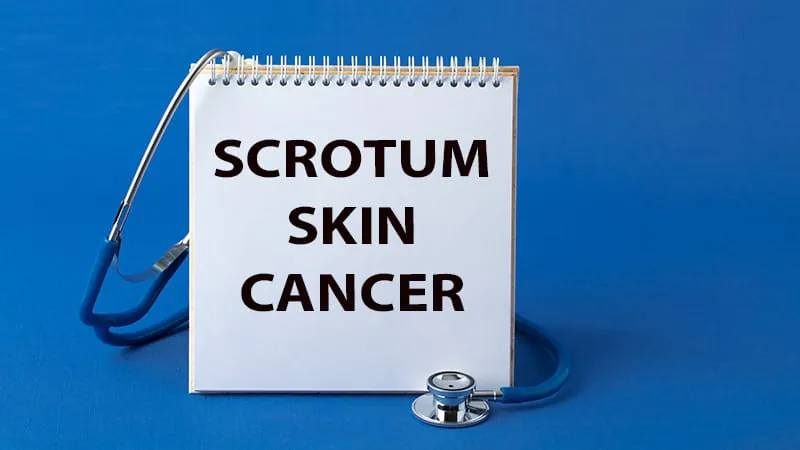 Scrotal squamous cell carcinoma on the rise in the US, with racial disparities in incidence