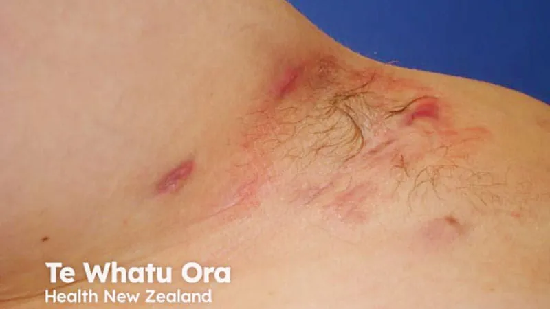 First-ever AAD guidelines set a new standard for hidradenitis suppurativa care