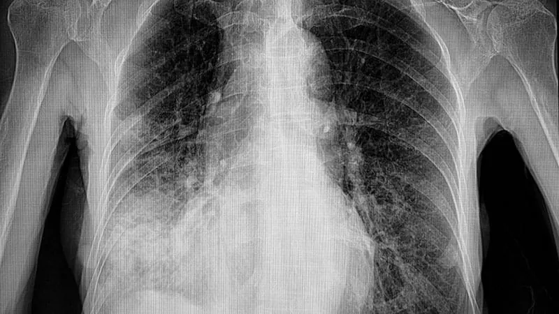 Respiratory infections dramatically raise heart attack and cardiovascular risk, study finds