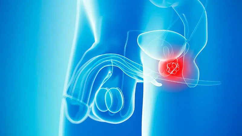 Adding darolutamide to standard therapy cuts metastasis risk by 58% in high-risk prostate cancer